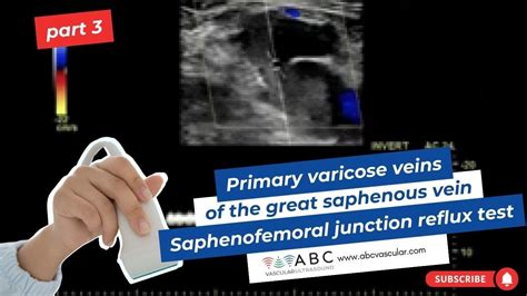 manual compression test great saphenous vein|varicose veins with gsv.